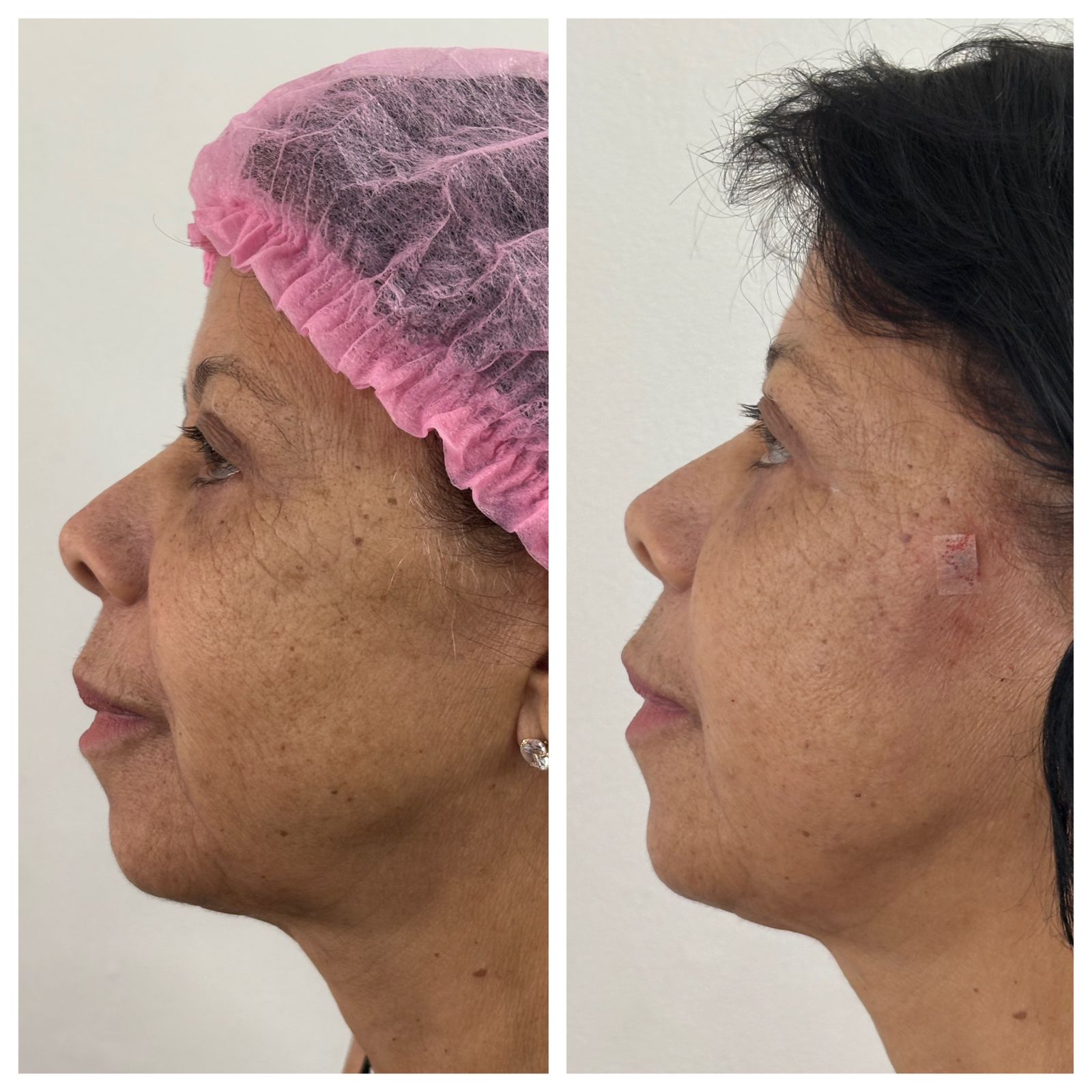 Resultado antes e depois