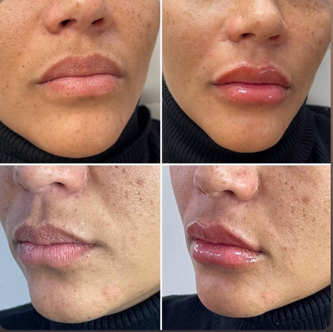 Resultado antes e depois